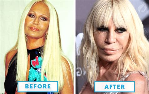 failed plastic surgeries|10 worst plastic surgery disasters.